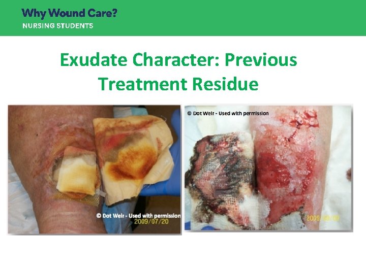 Exudate Character: Previous Treatment Residue Exudate Character: Previous Treatment Residue