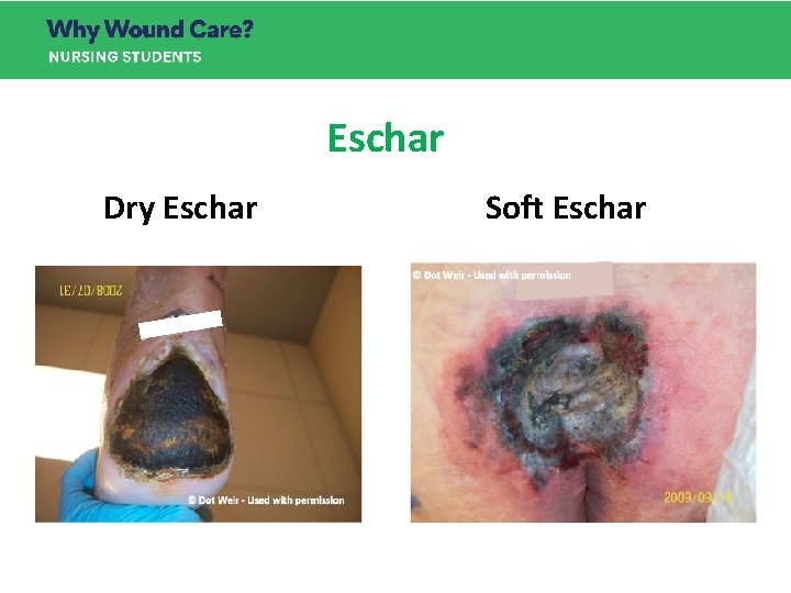 Eschar Dry Eschar Soft Eschar © Dot Weir - Used with permission Eschar Dry Eschar Soft Eschar © Dot Weir - Used with permission