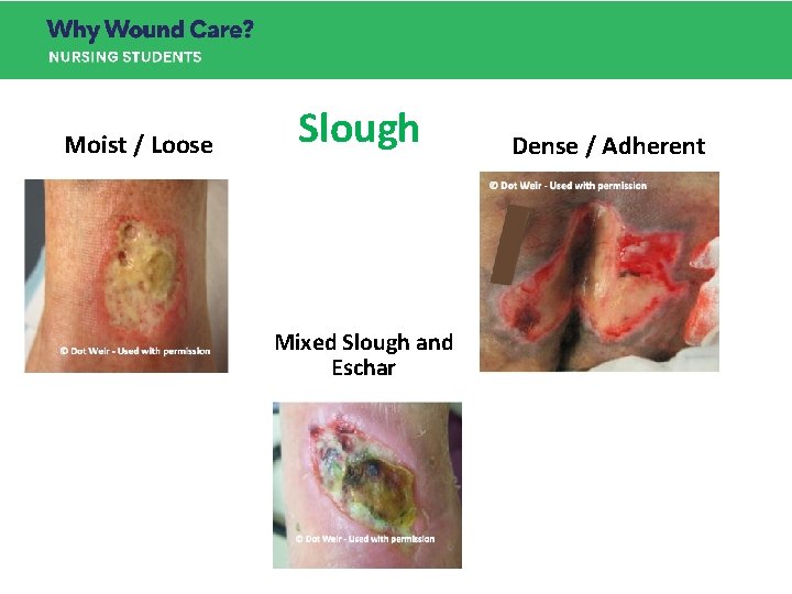 Slough wound