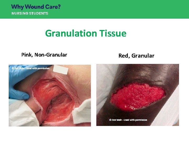 Granulation Tissue Pink, Non-Granular Red, Granular Granulation Tissue Pink, Non-Granular Red, Granular
