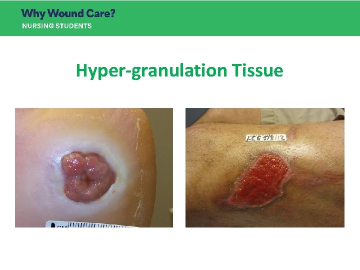 Hyper-granulation Tissue Hyper-granulation Tissue