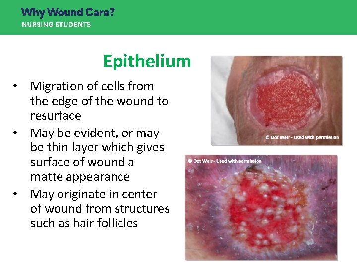 Epithelium • Migration of cells from the edge of the wound to resurface • Epithelium • Migration of cells from the edge of the wound to resurface •