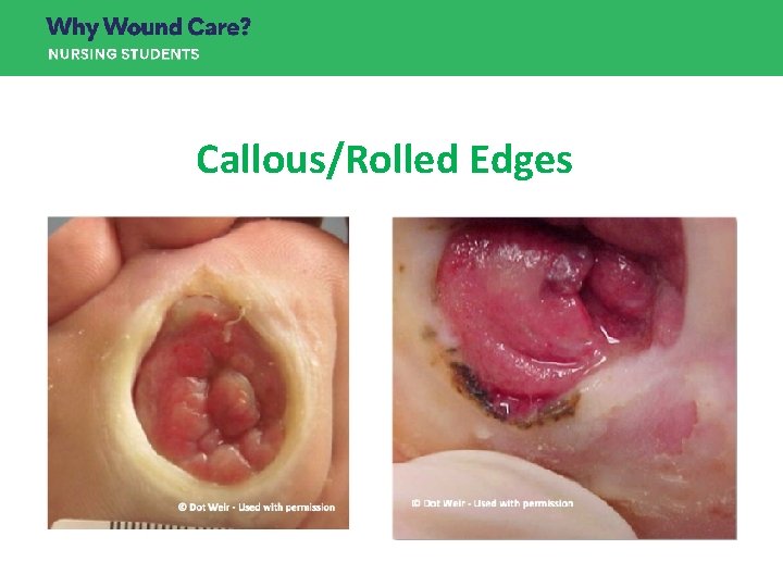 Callous/Rolled Edges Callous/Rolled Edges