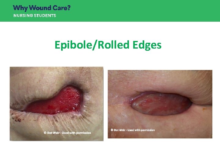 Epibole/Rolled Edges Epibole/Rolled Edges