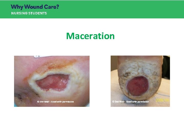 Maceration Maceration