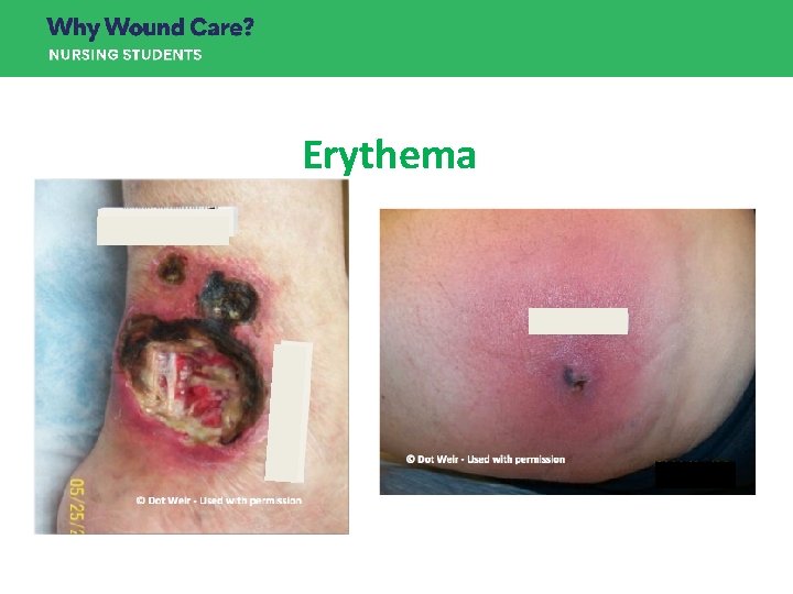 Erythema Erythema