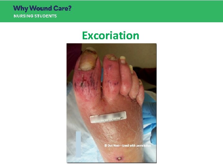 Excoriation Excoriation