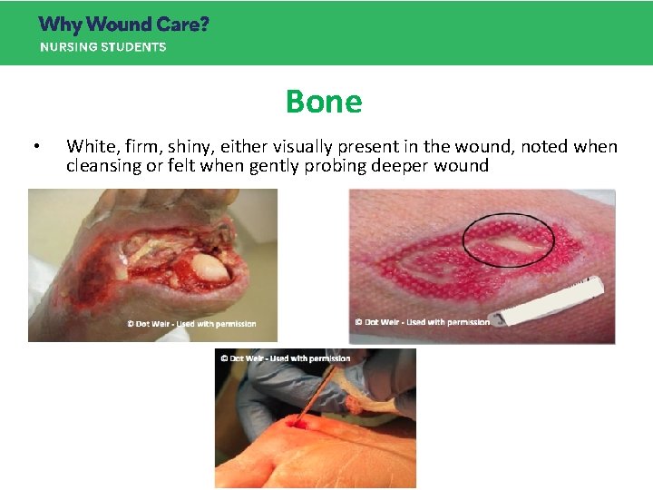 Bone • White, firm, shiny, either visually present in the wound, noted when cleansing Bone • White, firm, shiny, either visually present in the wound, noted when cleansing