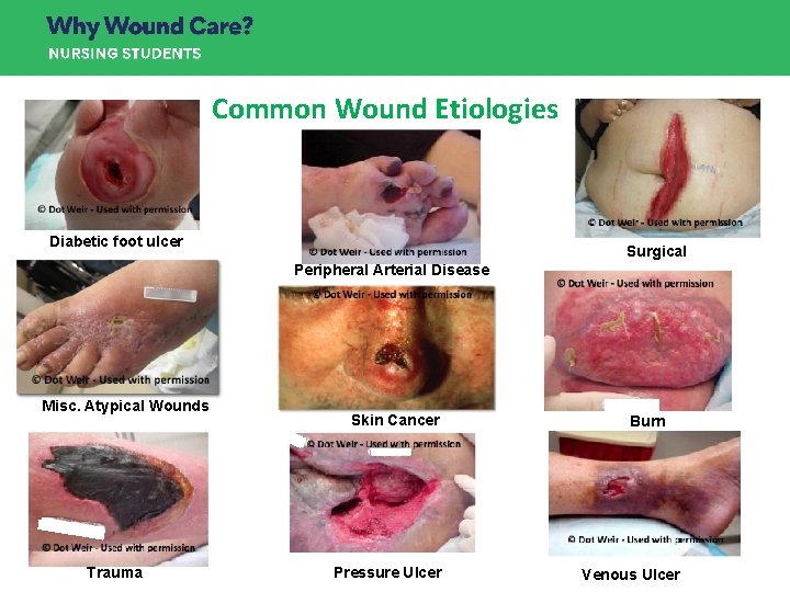 Common Wound Etiologies Diabetic foot ulcer Surgical Peripheral Arterial Disease Misc. Atypical Wounds Trauma Common Wound Etiologies Diabetic foot ulcer Surgical Peripheral Arterial Disease Misc. Atypical Wounds Trauma