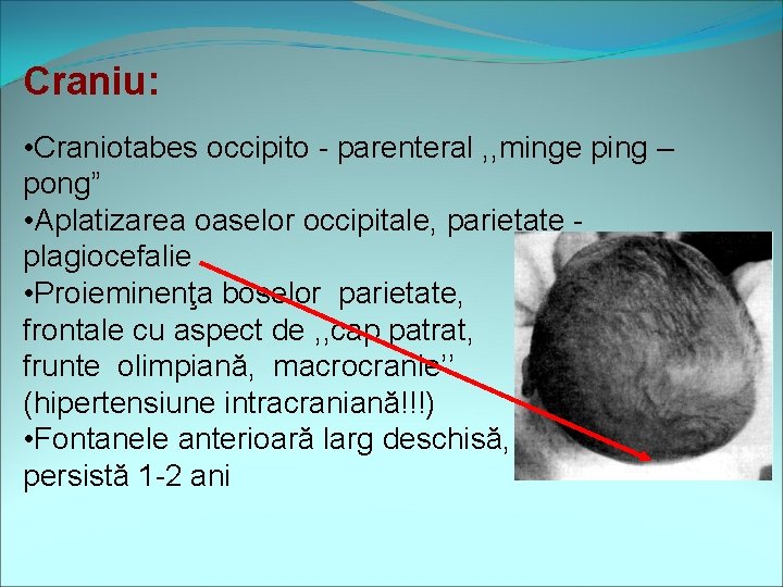 Craniu: • Craniotabes occipito - parenteral , , minge ping – pong” • Aplatizarea