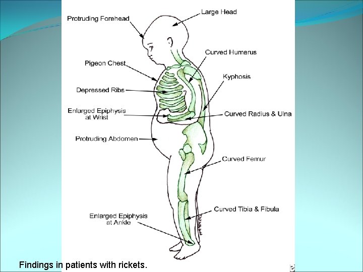 Findings in patients with rickets. 