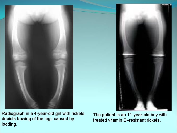 Radiograph in a 4 -year-old girl with rickets depicts bowing of the legs caused