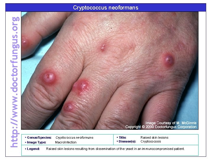 http: //www. doctorfungus. org Cryptococcus neoformans • Genus/Species: • Image Type: • Legend: Cryptococcus