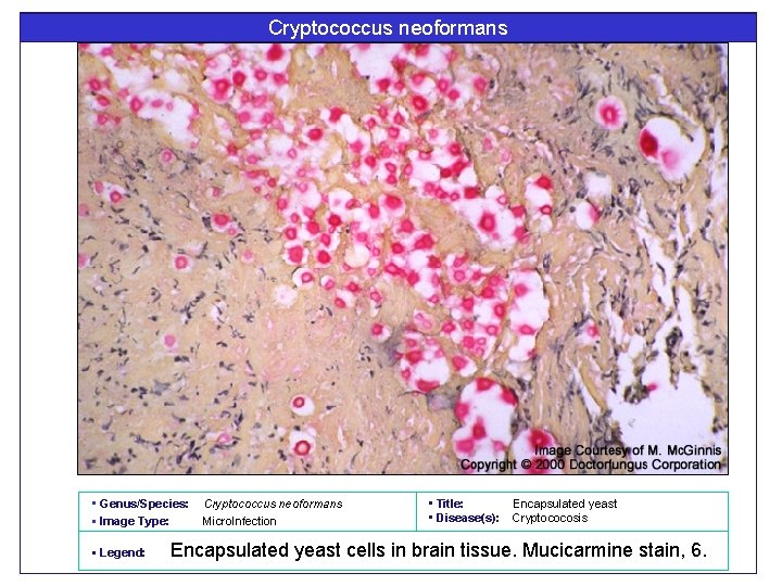 Cryptococcus neoformans • Genus/Species: • Image Type: • Legend: Cryptococcus neoformans Micro. Infection •