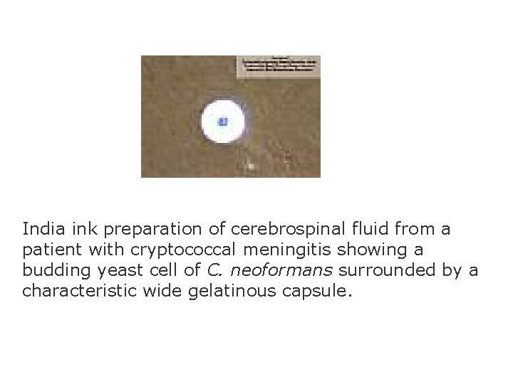 India ink preparation of cerebrospinal fluid from a patient with cryptococcal meningitis showing a