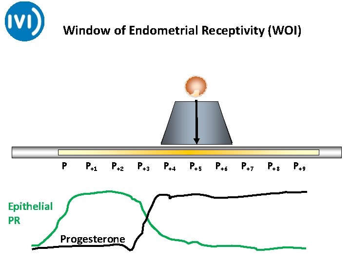 Window of Endometrial Receptivity (WOI) P P+1 P+2 Epithelial PR Progesterone P+3 P+4 P+5