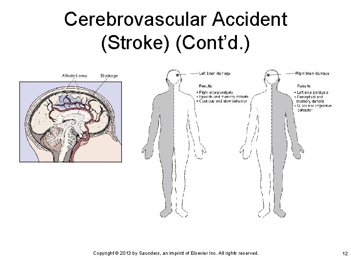 Cerebrovascular Accident (Stroke) (Cont’d. ) Copyright © 2013 by Saunders, an imprint of Elsevier