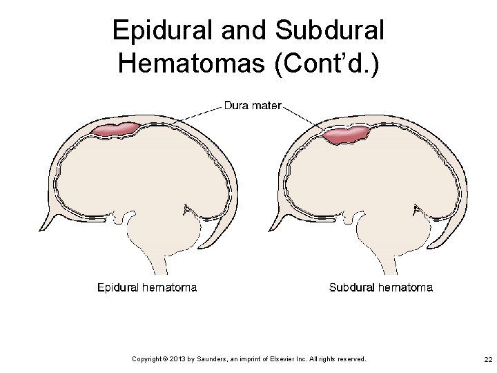 Epidural and Subdural Hematomas (Cont’d. ) Copyright © 2013 by Saunders, an imprint of