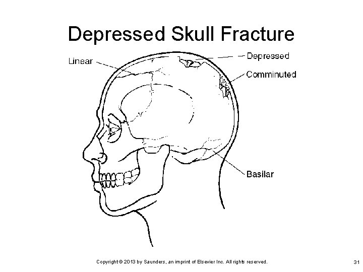 Depressed Skull Fracture Copyright © 2013 by Saunders, an imprint of Elsevier Inc. All