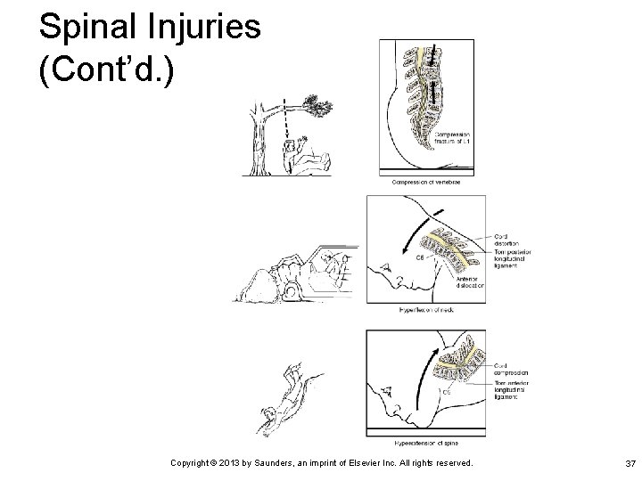 Spinal Injuries (Cont’d. ) Copyright © 2013 by Saunders, an imprint of Elsevier Inc.