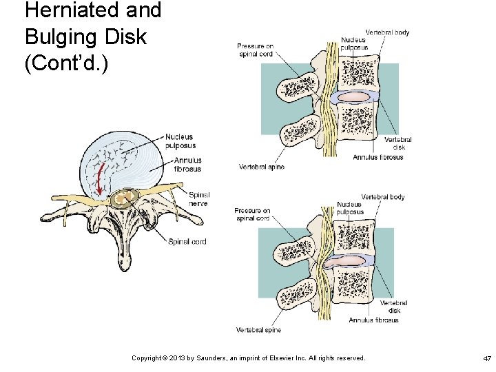 Herniated and Bulging Disk (Cont’d. ) Copyright © 2013 by Saunders, an imprint of