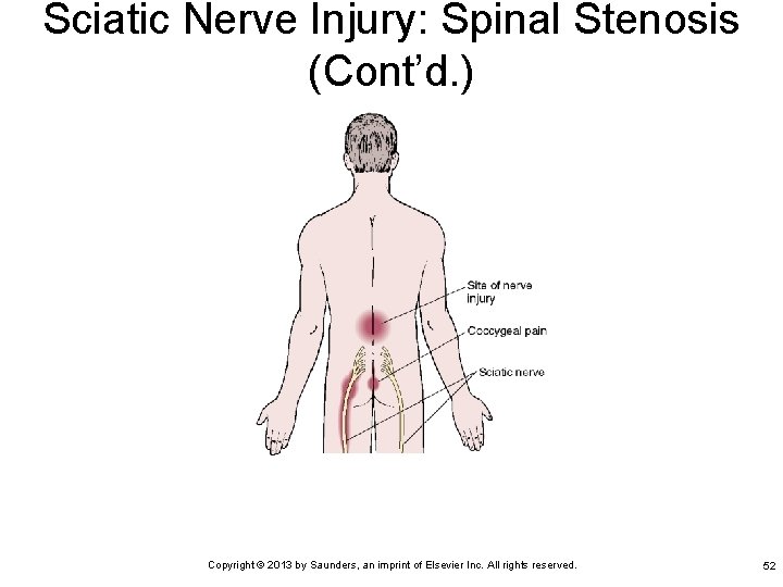 Sciatic Nerve Injury: Spinal Stenosis (Cont’d. ) Copyright © 2013 by Saunders, an imprint