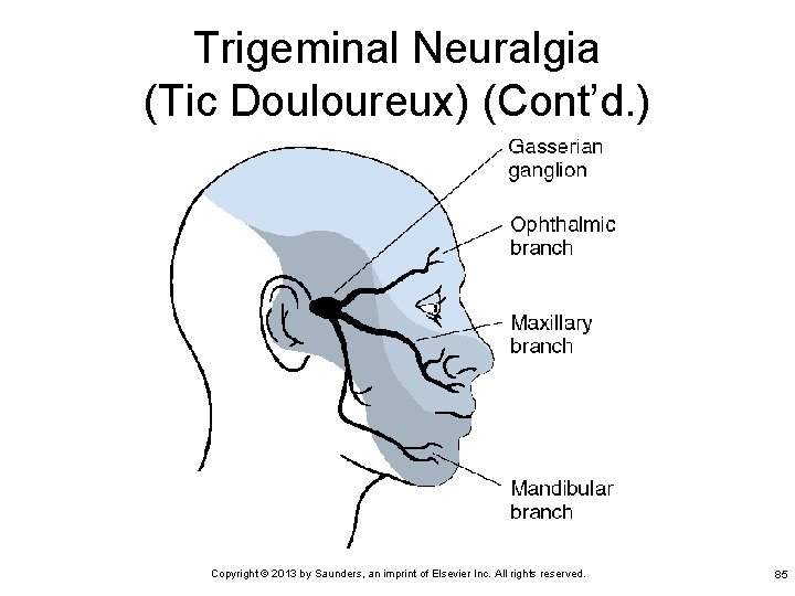 Trigeminal Neuralgia (Tic Douloureux) (Cont’d. ) Copyright © 2013 by Saunders, an imprint of