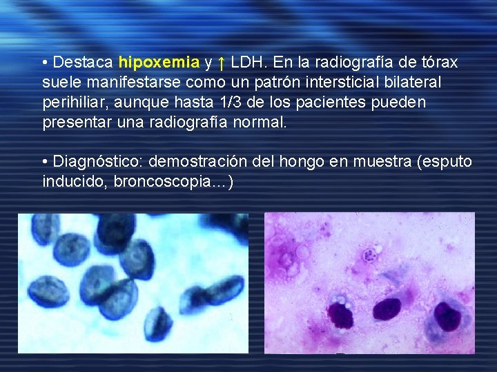  • Destaca hipoxemia y ↑ LDH. En la radiografía de tórax suele manifestarse