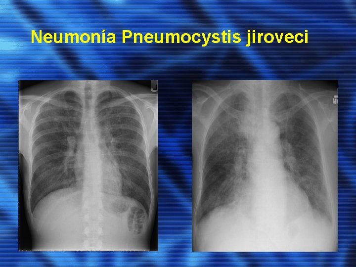 Neumonía Pneumocystis jiroveci 