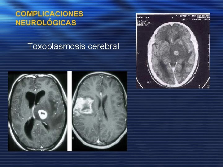 COMPLICACIONES NEUROLÓGICAS Toxoplasmosis cerebral 