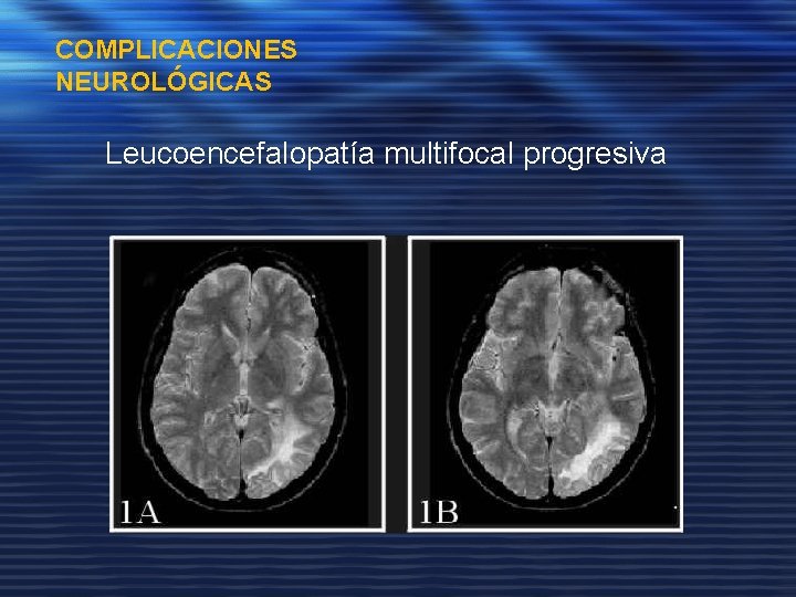 COMPLICACIONES NEUROLÓGICAS Leucoencefalopatía multifocal progresiva 