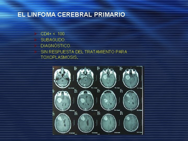 EL LINFOMA CEREBRAL PRIMARIO Ø Ø CD 4+ < 100 SUBAGUDO. DIAGNÓSTICO. SIN RESPUESTA