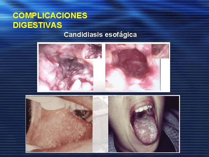 COMPLICACIONES DIGESTIVAS Candidiasis esofágica Candidiasis oral 