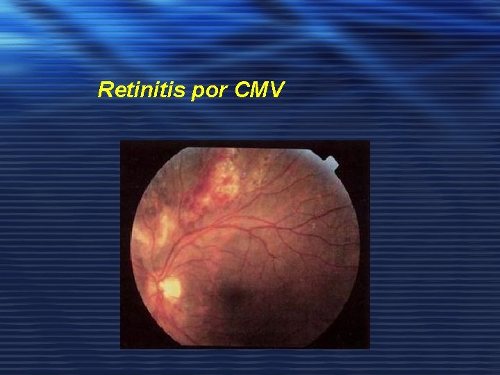 Retinitis por CMV 