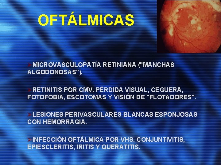 OFTÁLMICAS ØMICROVASCULOPATÍA RETINIANA ("MANCHAS ALGODONOSAS"). ØRETINITIS POR CMV. PÉRDIDA VISUAL, CEGUERA, FOTOFOBIA, ESCOTOMAS Y