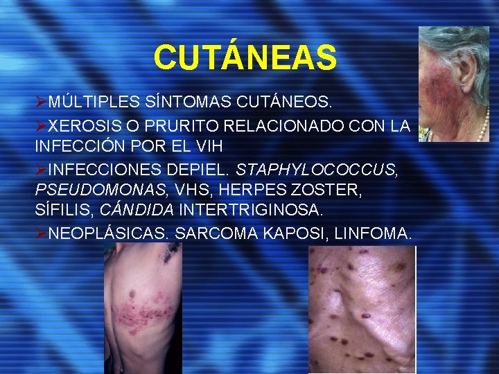 CUTÁNEAS ØMÚLTIPLES SÍNTOMAS CUTÁNEOS. ØXEROSIS O PRURITO RELACIONADO CON LA INFECCIÓN POR EL VIH