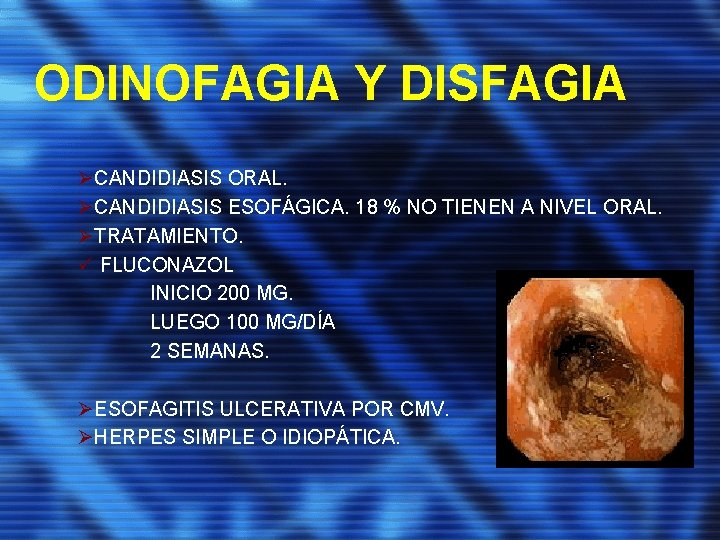 ODINOFAGIA Y DISFAGIA ØCANDIDIASIS ORAL. ØCANDIDIASIS ESOFÁGICA. 18 % NO TIENEN A NIVEL ORAL.