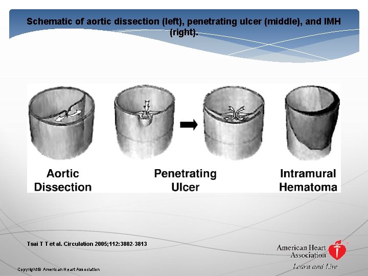 Schematic of aortic dissection (left), penetrating ulcer (middle), and IMH (right). Tsai T T