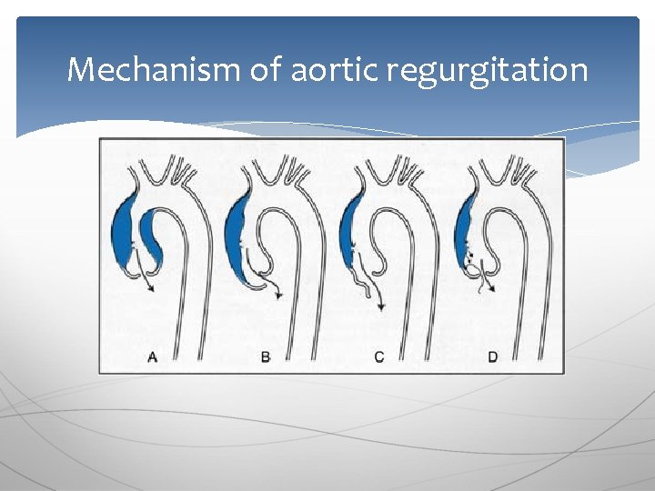 Mechanism of aortic regurgitation 