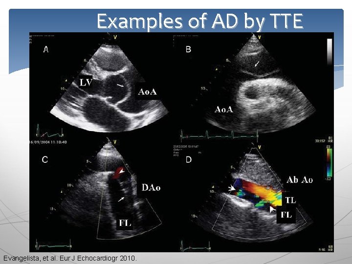 Examples of AD by TTE Evangelista, et al. Eur J Echocardiogr 2010. 