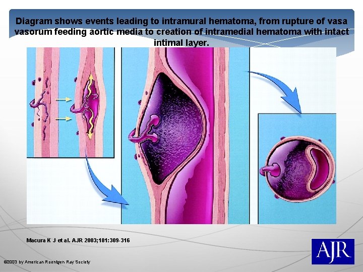 Diagram shows events leading to intramural hematoma, from rupture of vasa vasorum feeding aortic