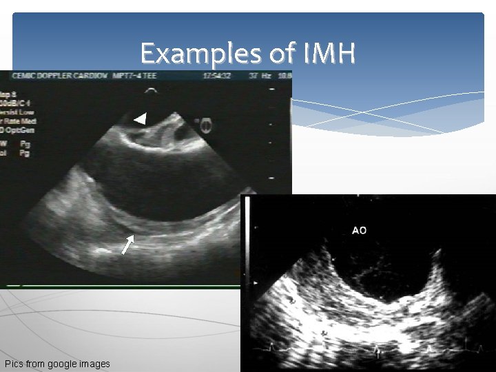 Examples of IMH Pics from google images 