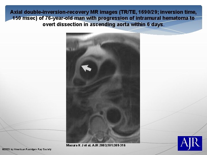 Axial double-inversion-recovery MR images (TR/TE, 1690/29; inversion time, 150 msec) of 76 -year-old man