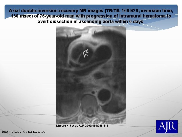 Axial double-inversion-recovery MR images (TR/TE, 1690/29; inversion time, 150 msec) of 76 -year-old man