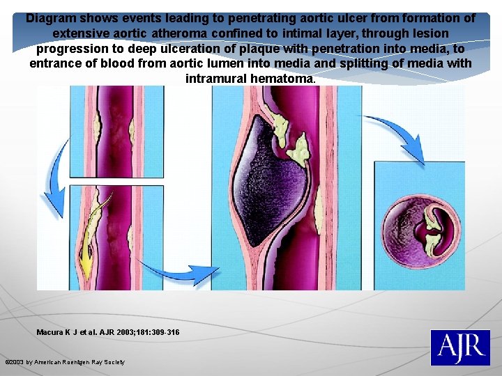 Diagram shows events leading to penetrating aortic ulcer from formation of extensive aortic atheroma