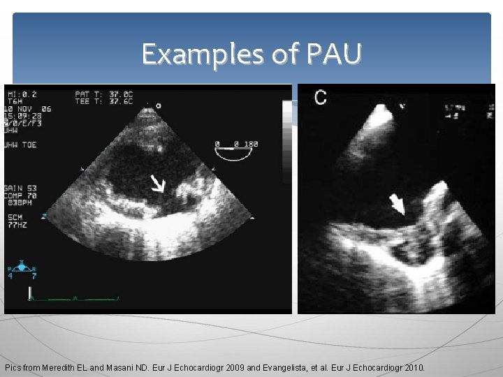 Examples of PAU Pics from Meredith EL and Masani ND. Eur J Echocardiogr 2009