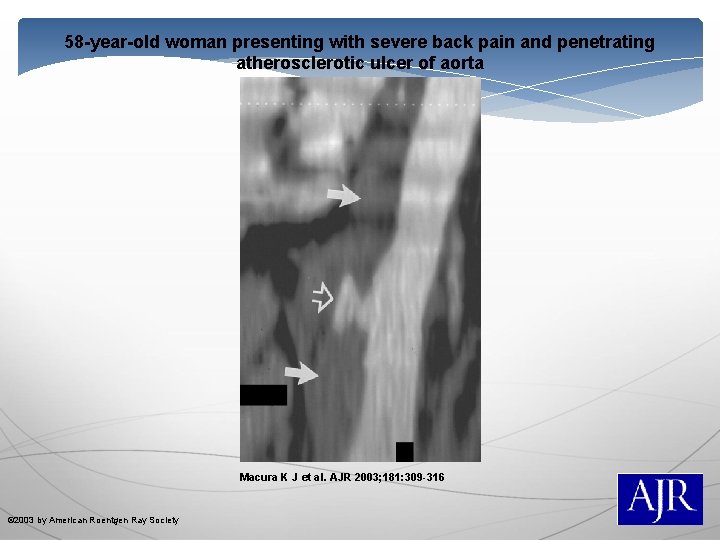 58 -year-old woman presenting with severe back pain and penetrating atherosclerotic ulcer of aorta