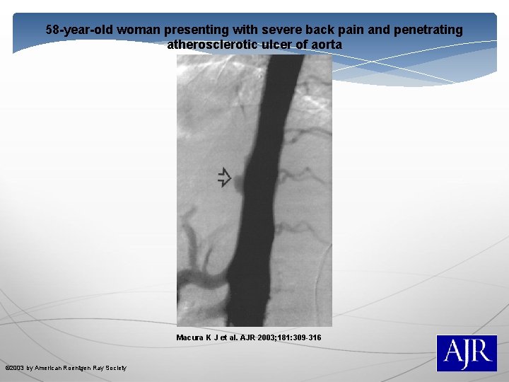 58 -year-old woman presenting with severe back pain and penetrating atherosclerotic ulcer of aorta