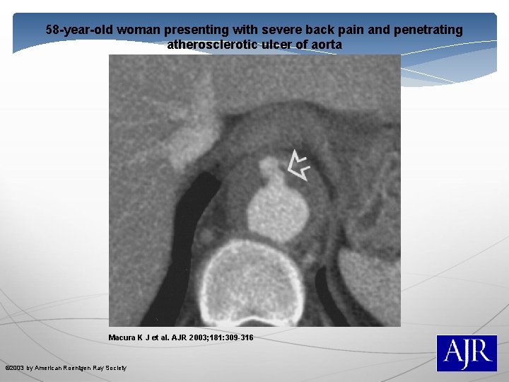 58 -year-old woman presenting with severe back pain and penetrating atherosclerotic ulcer of aorta