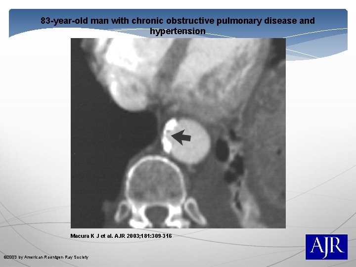 83 -year-old man with chronic obstructive pulmonary disease and hypertension Macura K J et